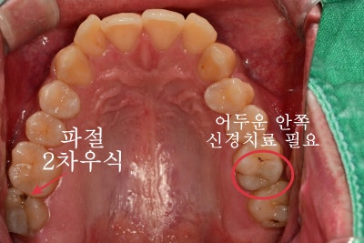 Perawatan Gigi di Seoul Jung-gu: Apakah Gigi yang Telah Dirawat Saraf Membutuhkan Mahkota? 사진 2