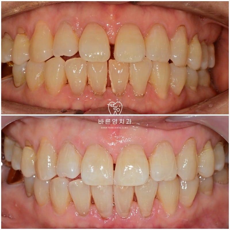 علاج الأسنان الأمامية المتباعدة والمتشققة (الشقوق) بالراتنج في عيادة ياكسو لطب الأسنان 사진 5