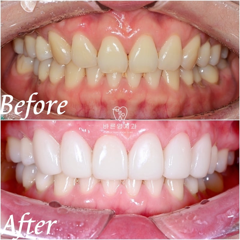 Dongdaemun No-Prep Veneers: When Past Orthodontic Treatment Makes Your Teeth Invisible When You Smile, Causing Stress 사진