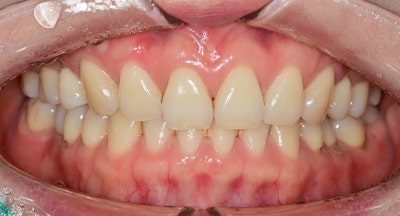 Dongdaemun No-Prep Veneers: When Past Orthodontic Treatment Makes Your Teeth Invisible When You Smile, Causing Stress