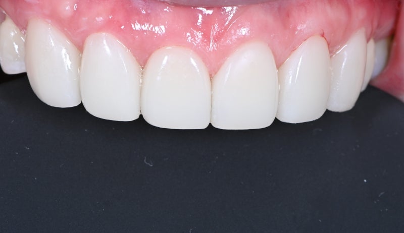 Dongdaemun No-Prep Veneers: When Past Orthodontic Treatment Makes Your Teeth Invisible When You Smile, Causing Stress
