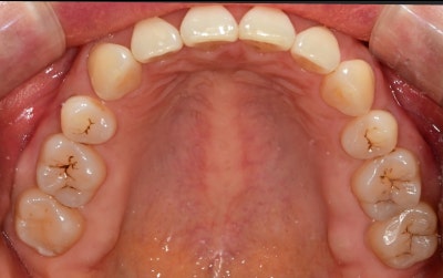 Dongdaemun No-Prep Veneers: When Past Orthodontic Treatment Makes Your Teeth Invisible When You Smile, Causing Stress 사진