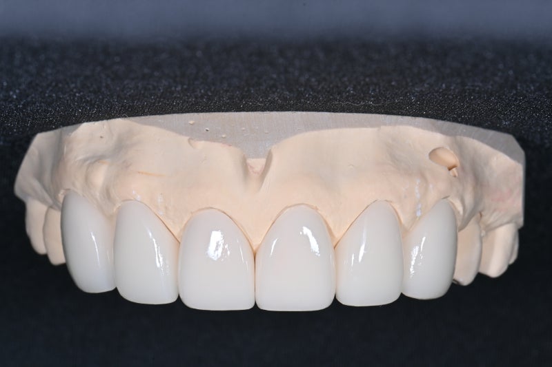Dongdaemun No-Prep Veneers: When Past Orthodontic Treatment Makes Your Teeth Invisible When You Smile, Causing Stress 사진