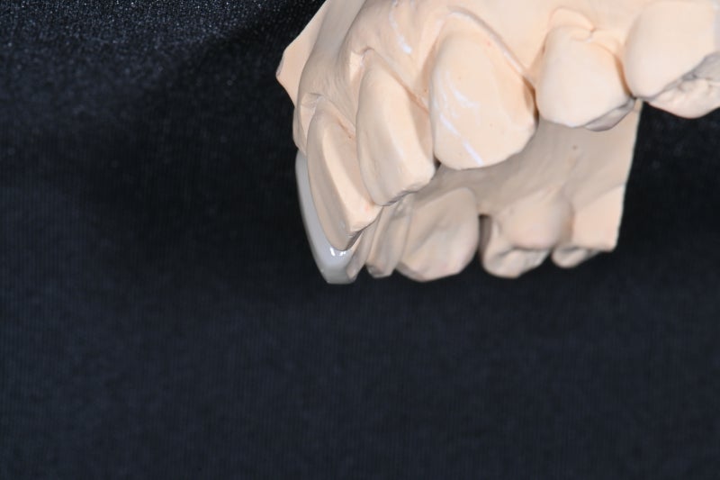 Dongdaemun No-Prep Veneers: When Past Orthodontic Treatment Makes Your Teeth Invisible When You Smile, Causing Stress 사진