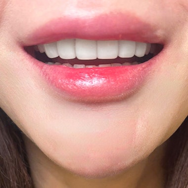Dongdaemun No-Prep Veneers: When Past Orthodontic Treatment Makes Your Teeth Invisible When You Smile, Causing Stress 사진
