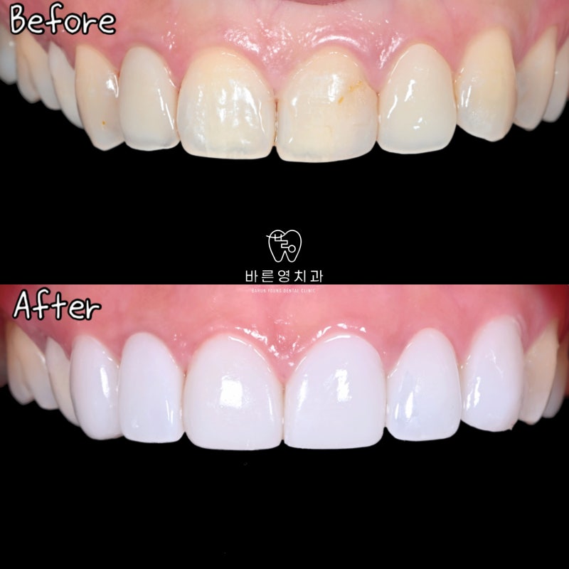 Jika Anda ingin melakukan veneer gigi di klinik gigi Stasiun Yaksu, sebaiknya pahami hal ini terlebih dahulu (proses men