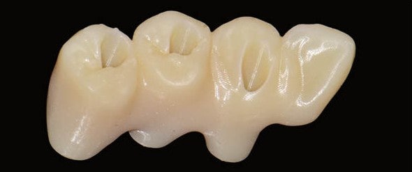 Hannam-dong Dental Clinic: Digital Implants Reduce Errors and Increase Comfort 사진 8