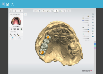 Hannam-dong Dental Clinic: Digital Implants Reduce Errors and Increase Comfort 사진 4