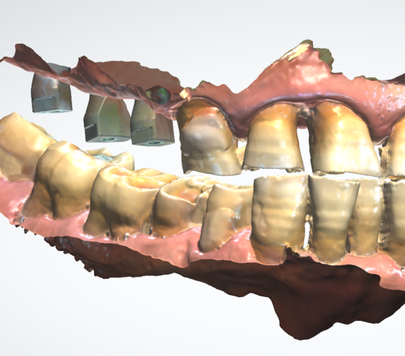 Hannam-dong Dental Clinic: Digital Implants Reduce Errors and Increase Comfort 사진 7
