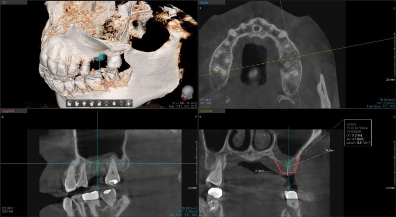 Yaksu Station Dental Implants: When is Implant Surgery Possible After Extraction? 사진 6