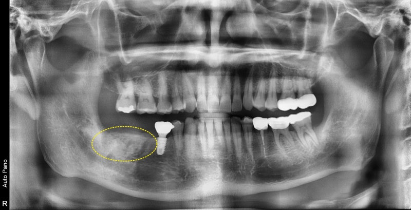 Yaksu Station Dental Implants: When is Implant Surgery Possible After Extraction? 사진 3