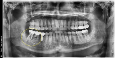 Yaksu Station Dental Implants: When is Implant Surgery Possible After Extraction?