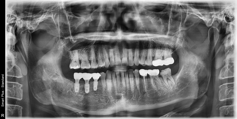 Yaksu Station Dental Implants: When is Implant Surgery Possible After Extraction? 사진 4