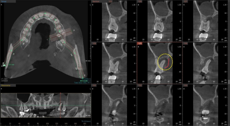 Yaksu Station Dental Implants: When is Implant Surgery Possible After Extraction? 사진 5