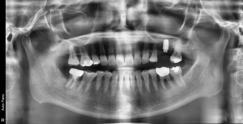 Yaksu Station Dental Implants: When is Implant Surgery Possible After Extraction? 사진 7