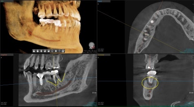 Yaksu Station Dental Implants: When is Implant Surgery Possible After Extraction?