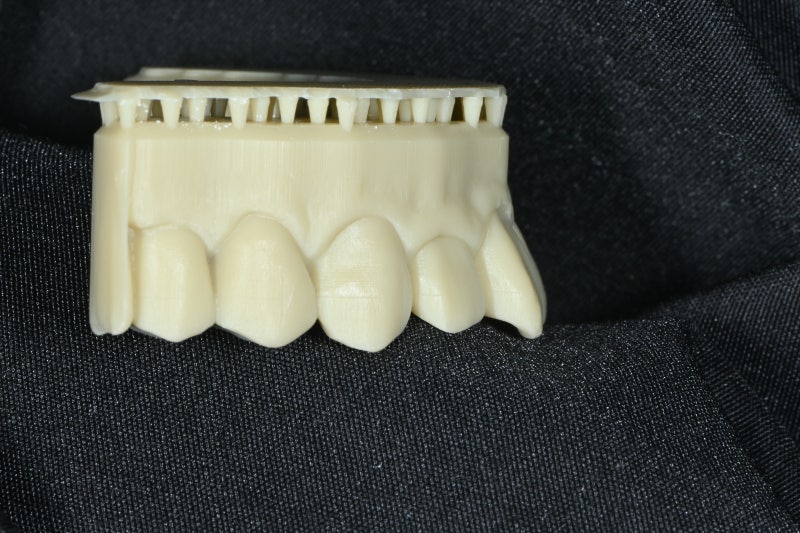 Is a Diagnostic Model Necessary for Laminate Treatment?? (No-Prep / Minimal-Prep Laminates)