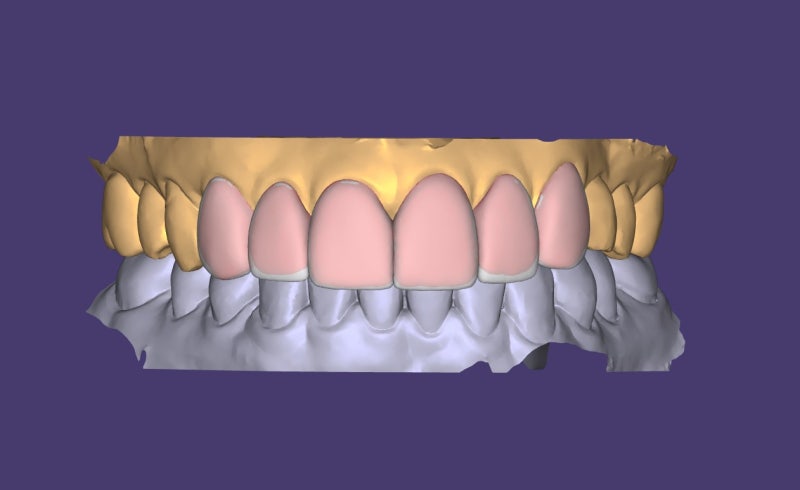 Is a Diagnostic Model Necessary for Laminate Treatment?? (No-Prep / Minimal-Prep Laminates)