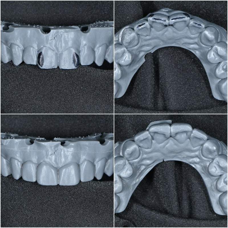 Is a Diagnostic Model Necessary for Laminate Treatment?? (No-Prep / Minimal-Prep Laminates) 사진 4