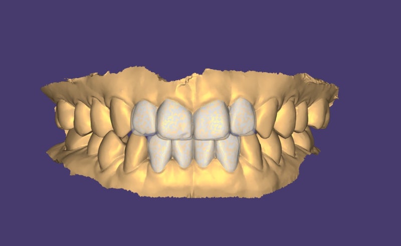 Is a Diagnostic Model Necessary for Laminate Treatment?? (No-Prep / Minimal-Prep Laminates) 사진 7