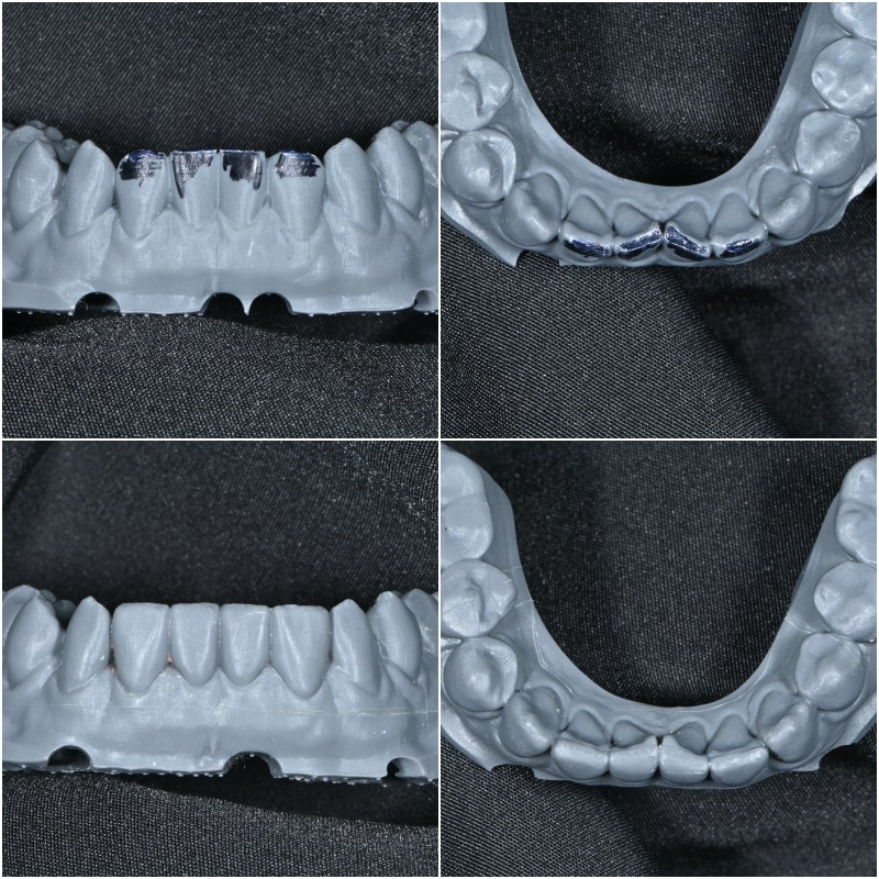Is a Diagnostic Model Necessary for Laminate Treatment?? (No-Prep / Minimal-Prep Laminates) 사진 5