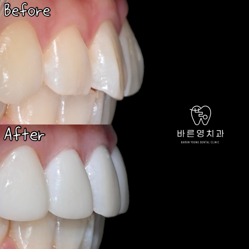 Is a Diagnostic Model Necessary for Laminate Treatment?? (No-Prep / Minimal-Prep Laminates) 사진 3