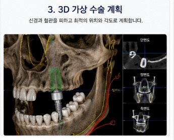 Operasi Implan yang Efisien dan Keunggulan Menggunakan Peralatan Digital di Klinik Gigi Yaksuyeok 사진 5