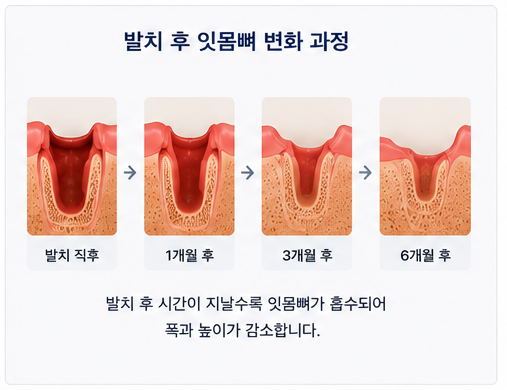 Yaksu Station Dental Clinic: How is the timing for implant placement after extraction determined? 사진 2