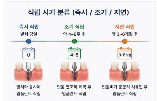 Yaksu Station Dental Clinic: How is the timing for implant placement after extraction determined? 사진 3