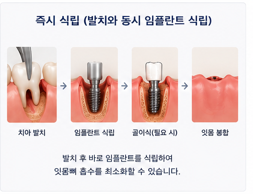 Yaksu Station Dental Clinic: How is the timing for implant placement after extraction determined? 사진 4