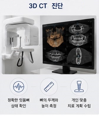 Yaksu Station Dental Implants: Is Bone Grafting Always Necessary? 사진 4