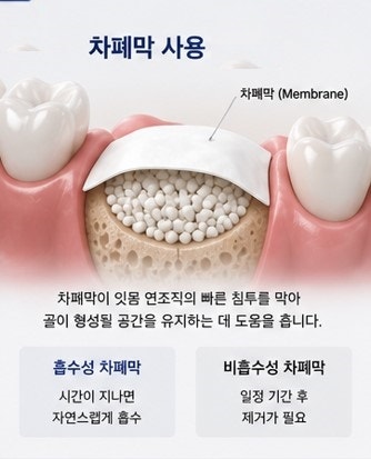 Yaksu Station Dental Implants: Is Bone Grafting Always Necessary? 사진 2