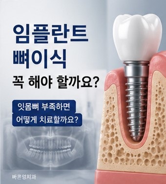 Yaksu Station Dental Implants: Is Bone Grafting Always Necessary?