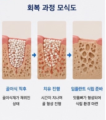 Yaksu Station Dental Implants: Is Bone Grafting Always Necessary?