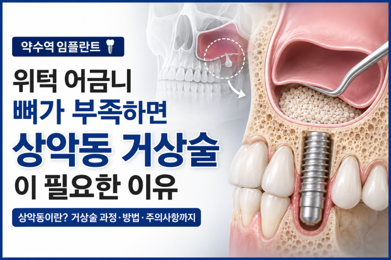 Klinik Gigi Yaksu Station, Sinus Lift Implan, Kapan Benar-benar Dibutuhkan? 사진 10