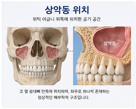 Klinik Gigi Yaksu Station, Sinus Lift Implan, Kapan Benar-benar Dibutuhkan?