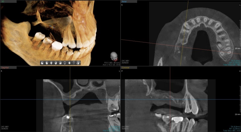 Klinik Gigi Yaksu Station, Sinus Lift Implan, Kapan Benar-benar Dibutuhkan? 사진 8