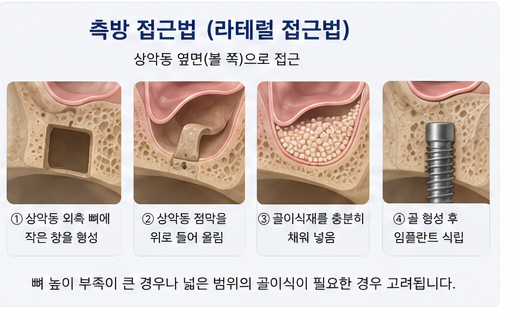 Klinik Gigi Yaksu Station, Sinus Lift Implan, Kapan Benar-benar Dibutuhkan? 사진 6