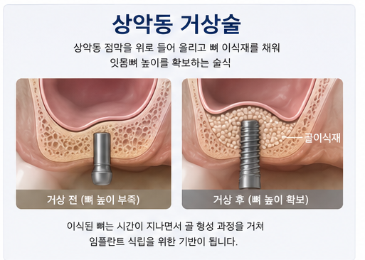 Klinik Gigi Yaksu Station, Sinus Lift Implan, Kapan Benar-benar Dibutuhkan? 사진 3