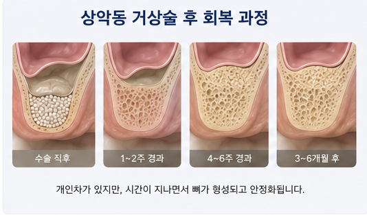 Klinik Gigi Yaksu Station, Sinus Lift Implan, Kapan Benar-benar Dibutuhkan? 사진 7