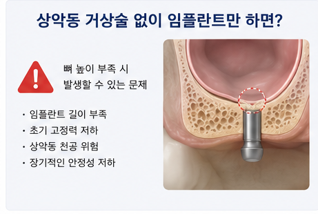 Klinik Gigi Yaksu Station, Sinus Lift Implan, Kapan Benar-benar Dibutuhkan? 사진 4