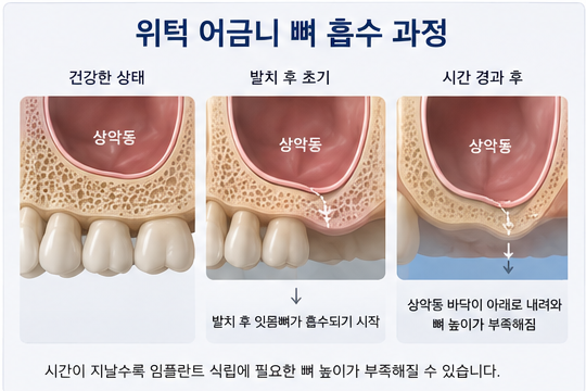 Klinik Gigi Yaksu Station, Sinus Lift Implan, Kapan Benar-benar Dibutuhkan? 사진 2