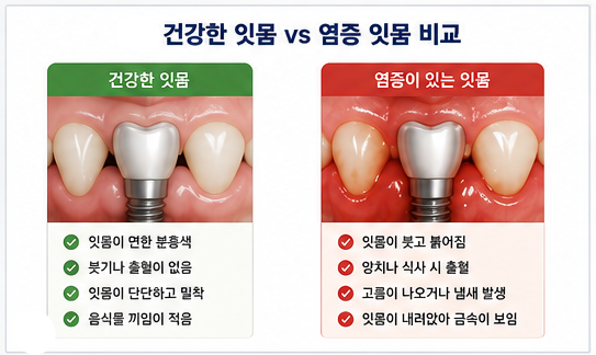 Yaksu Station Dental Clinic: Can Implants Also Get Gum Disease?