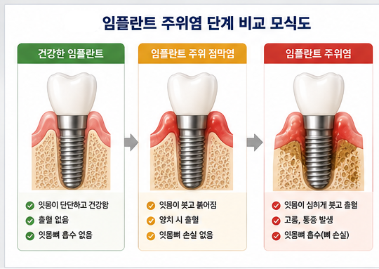 Yaksu Station Dental Clinic: Can Implants Also Get Gum Disease?