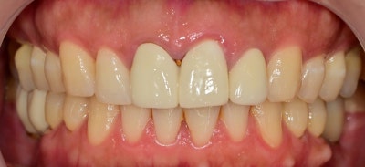 Klinik Gigi Yaksu Station: Veneer vs All-Ceramic, Perawatan Mana yang Lebih Baik? 사진 2