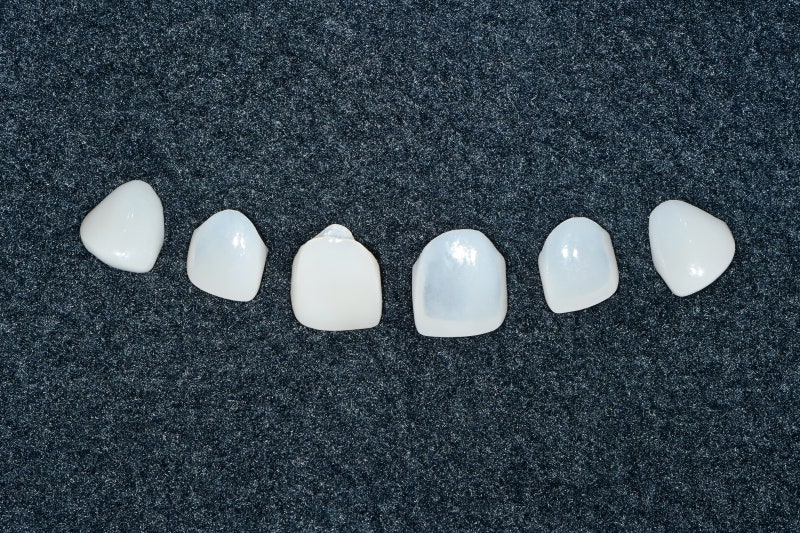 Klinik Gigi Yaksu Station: Veneer vs All-Ceramic, Perawatan Mana yang Lebih Baik?