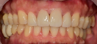 Klinik Gigi Yaksu Station: Veneer vs All-Ceramic, Perawatan Mana yang Lebih Baik? 사진 3