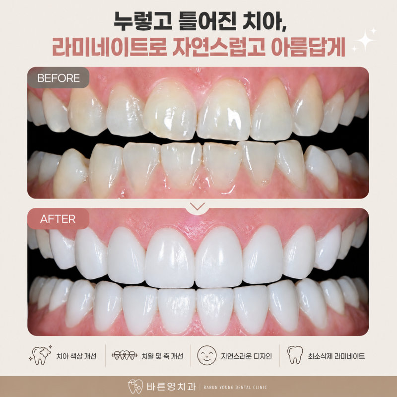 Klinik Gigi Yaksu Station: Veneer vs All-Ceramic, Perawatan Mana yang Lebih Baik?