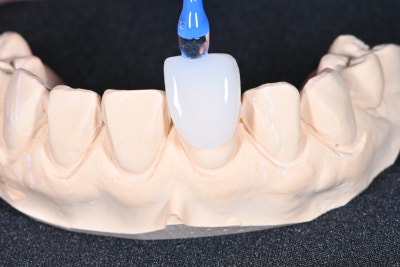 Klinik Gigi Yaksu Station: Veneer vs All-Ceramic, Perawatan Mana yang Lebih Baik? 사진 5