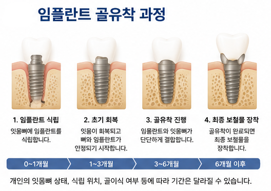 Yaksu Station Full Mouth Implants: How to Manage Immediate Temporary Dentures After Surgery? 사진 2